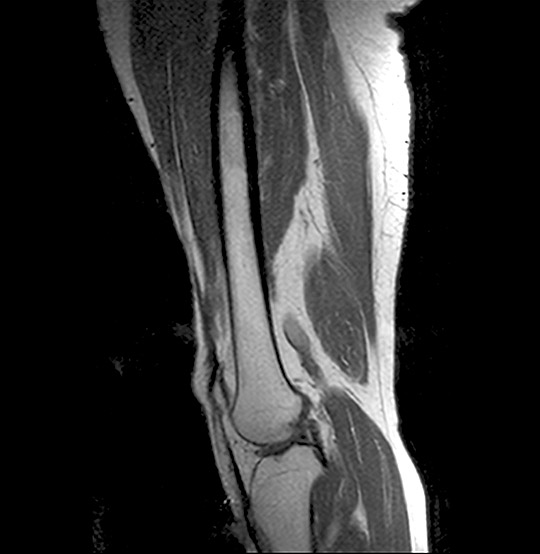 MRI Upper Leg Coronal Scan (AI Enhanced)